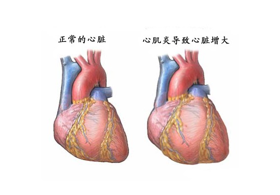 心肌炎有什么症状,怎么治疗?