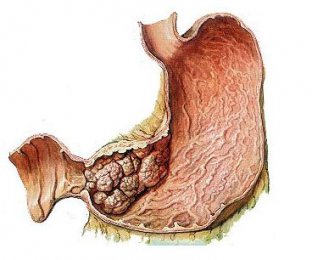胃恶性肿瘤的病因详解