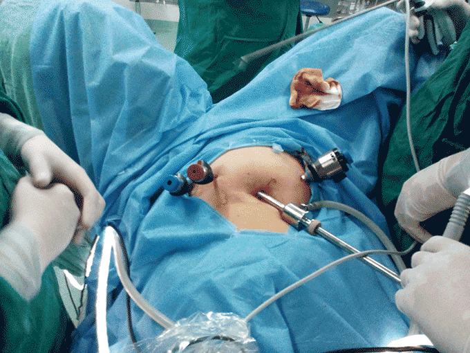腹腔镜下直肠癌根治术的腹部手术小切口