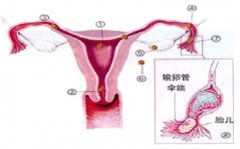 妇产科多种方式治愈宫外孕