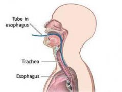日常预防食管炎的方法