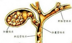 胆结石要做哪些检查