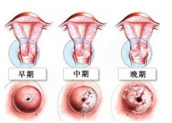 科室特色——高频环形电切术（LEEP刀）治疗宫颈疾病