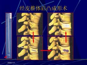 骨科特色疗法——椎体成形术