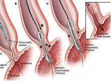 消化内科科室特色--内镜下食管狭窄扩张术