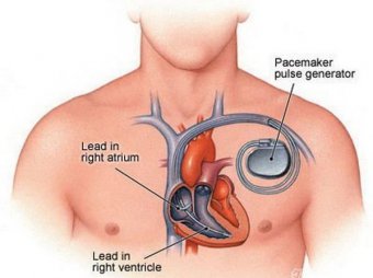 心脏起搏器植入术