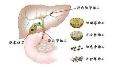 胆道切开取石术