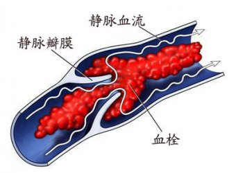 静脉溶栓为急性脑梗死患者带来福音