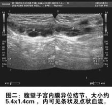 腹壁子宫内膜异位症