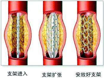 冠脉支架植入术