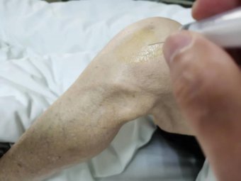 疼痛康复科特色诊疗技术—正清风痛宁三联序贯疗法治疗膝关节骨性关节炎