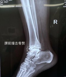 精于微创|山医集团潍坊市市立医院骨二科成功开展踝关节镜下微创踝关节外侧韧带重建手术