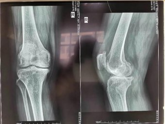 精于微创|山医集团潍坊市市立医院骨二科成功开展全膝关节置换术