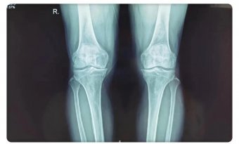专于骨科,精于微创——骨二科近日完成一例膝关节骨性关节炎单髁关节置换手术