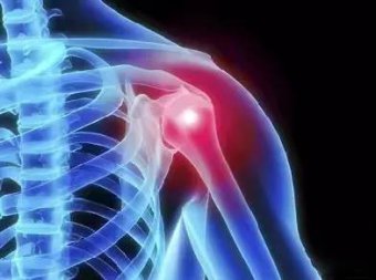 肩周炎治疗新方法——正清风痛宁三联序贯疗法科学治疗肩周炎