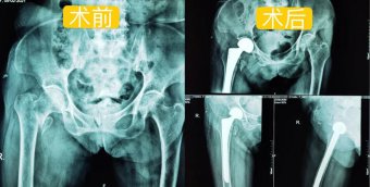 【案例分享】老年股骨转子间骨折治疗新选择——人工髋关节置换